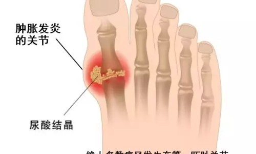 蛋白粉结石病人可以吃吗-蛋白质粉结石病人能吃吗网 - 蛋白粉胆结石的人能吃吗,蛋白粉对结石有影响吗